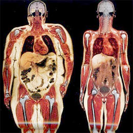 XRAY OF VISCERAL FAT VS SUBCUTANEOUS